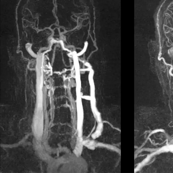 CT Angiography Neck Vessel
